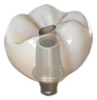 Picture of Free Crowns On Digital Base Abutments (BlueSkyBio.com)